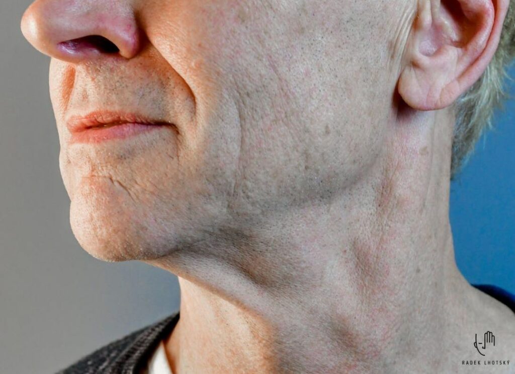 Redukce submandibulární  žlázy při deep plane faceliftu a neckliftu, Dr. Radek Lhotský