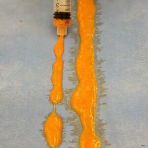 Nanofat grafting je metoda přenosu vlastního tuku využívající kmenové buňky