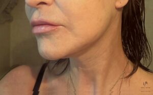 Perfektní kontura čelisti, ostrá jawline, po operace deep plane facelift a necklift