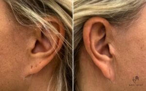 Pixie ear deformita ušních lalůčků, MUDr. Radek Lhotský
