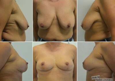 Před a po fotografie modelace prsou s redukcí, MUDr. Radek Lhotský