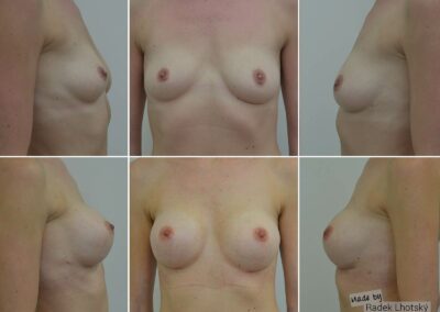 Před a po fotografie - augmentace, zvětšení prsou, anatomické implantáty 295 cc a 345 cc, MUDr. Radek Lhotský