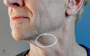 Submandibulární slinná žláza u mužského pacienta před vyjmutím při deep plane faceliftu