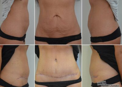 Abdominoplasty before and after pictures, Dr Radek Lhotsky