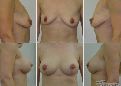 Bruststraffung mit Implantat und Eigenfett, Vorher- und Nachher, DrRadekLhotsky