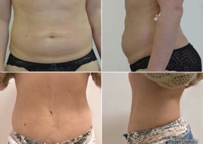Výsledek abdominoplastiky 2 roky po operaci, před a po fotografie, MUDr. Radek Lhotský
