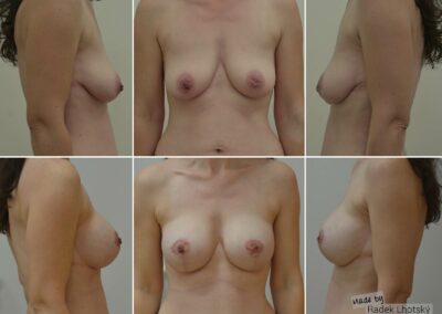 Breast lift with augmentation, before and after pictures, Dr Radek Lhotsky MD
