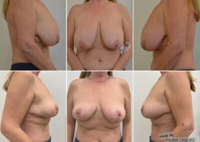 Před a po fotografie redukce prsou, zmenšení prsou - MUDr. Radek Lhotský