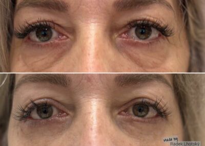 Před a po fotografie operace dolních víček, MUDr. Radek Lhotský