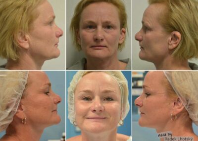 Deep Plane Facelift, 3 Jahre nach der Operation, Vorher-/Nachher-Bilder