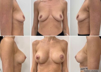 Before and After pictures of a breast lift with augmentation using an anatomical breast implant, Dr Radek Lhotsky MD