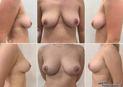 Before after pictures of a breast lift using additonal lipotransfer - lipografting, Dr Radek Lhotsky MD