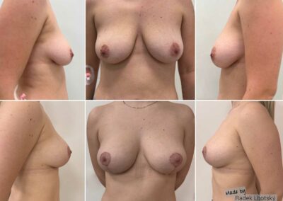 Bruststraffung mit Eigenfett, Dr.med. Radek Lhotsky, Facharzt für Plastische und Ästhetische Chirurgie