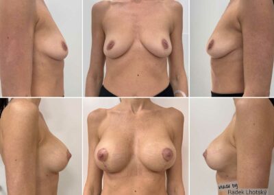 Bruststraffung mit Implantat, Dr.med. Radek Lhotsky, Facharzt für Plastische und Ästhetische Chirurgie