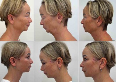 Deep Plane Facelift a Necklift - před a po fotografie MUDr. Radek Lhotský