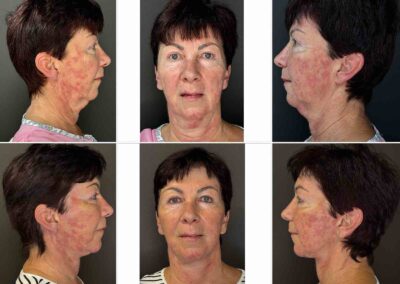 Deep Plane Facelift a Necklift - před a po fotografie MUDr. Radek Lhotský