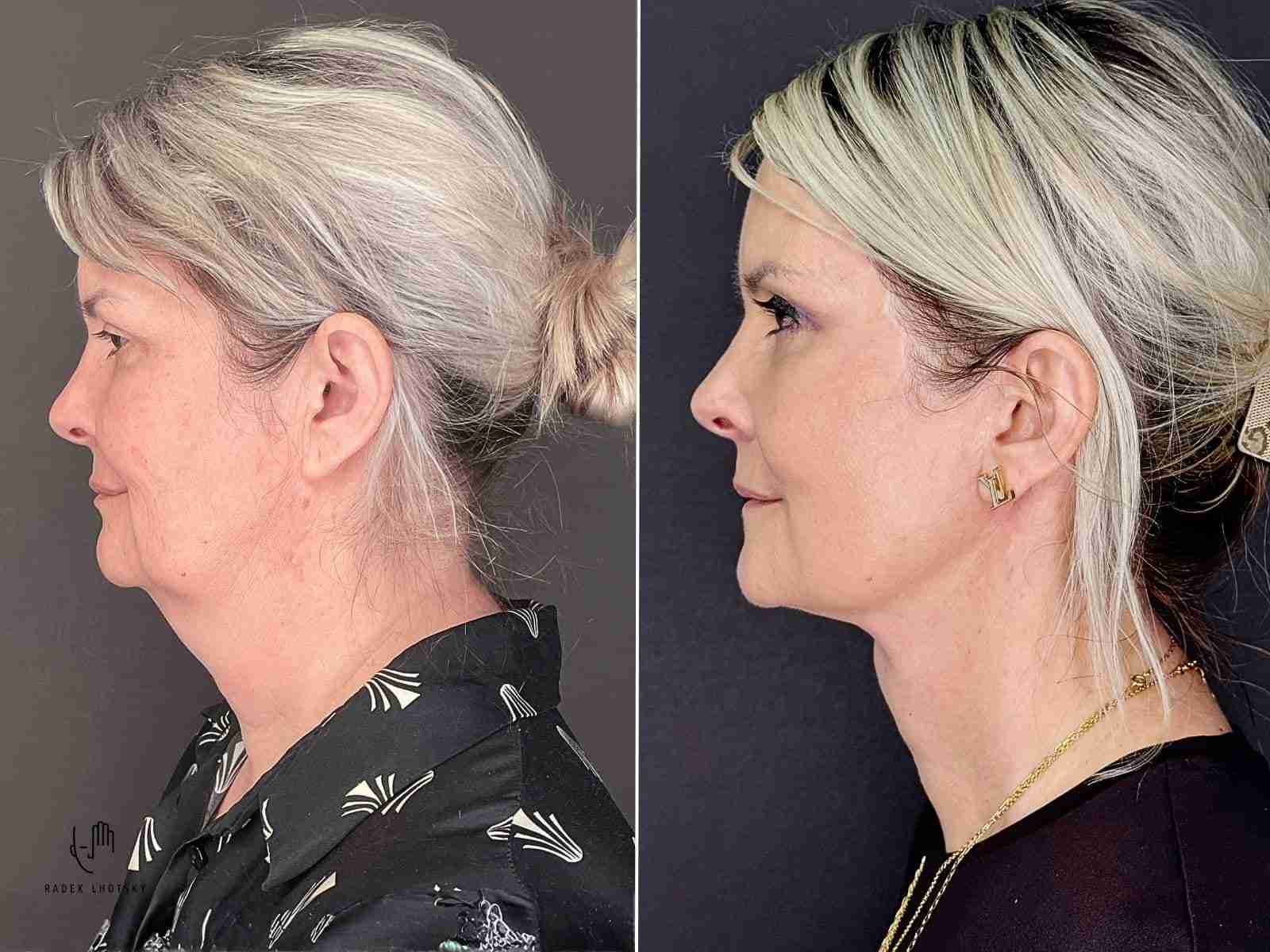Anatomie obličeje - vrstvy ošetřované operací Facelift