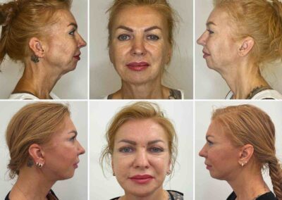 Deep Plane Facelift a Necklift, resekce slinné žlázy - před a po fotografie MUDr. Radek Lhotský