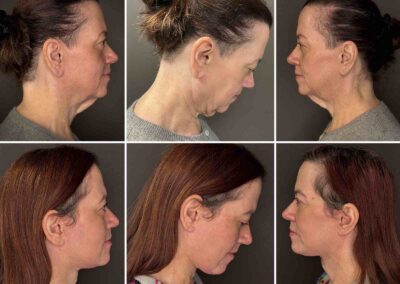 Deep Plane Facelift a Necklift , resekce slinné žlázy - před a po fotografie MUDr. Radek Lhotský