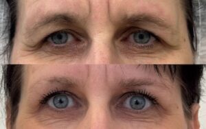 Přímý Browlift MUDr. Radek Lhotský