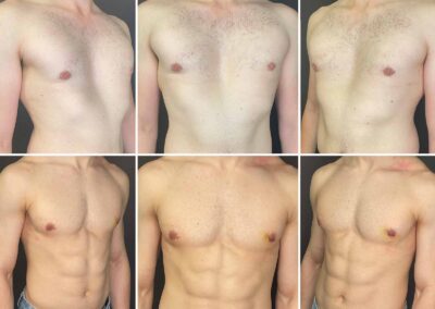 Gynekomastie - před a po - MUDr. Radek Lhotský