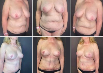 Kombinovaná operace: modelace prsou a abdominoplastika - MUDr. Radek Lhotský