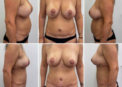 Kombinovaná operace: extrakce implantátu, modelace prsou, doplnění vlastním tukem, abdominoplastika - MUDr. Radek Lhotský