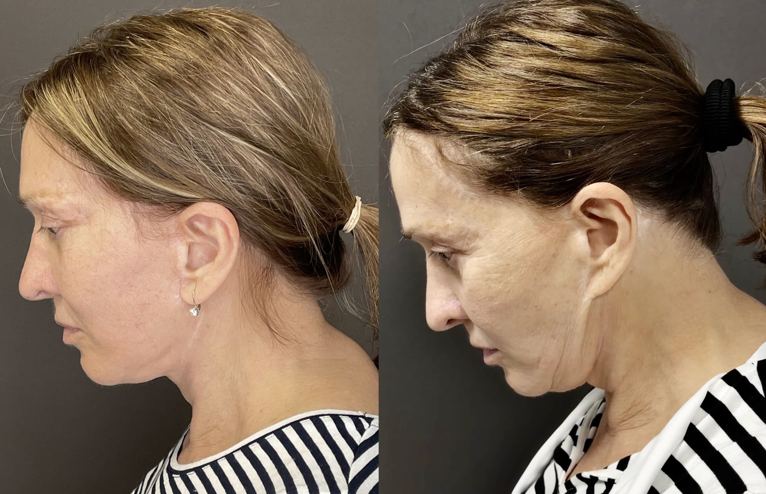 Korekce ušních lalůčků při operaci Deep Plane Facelift