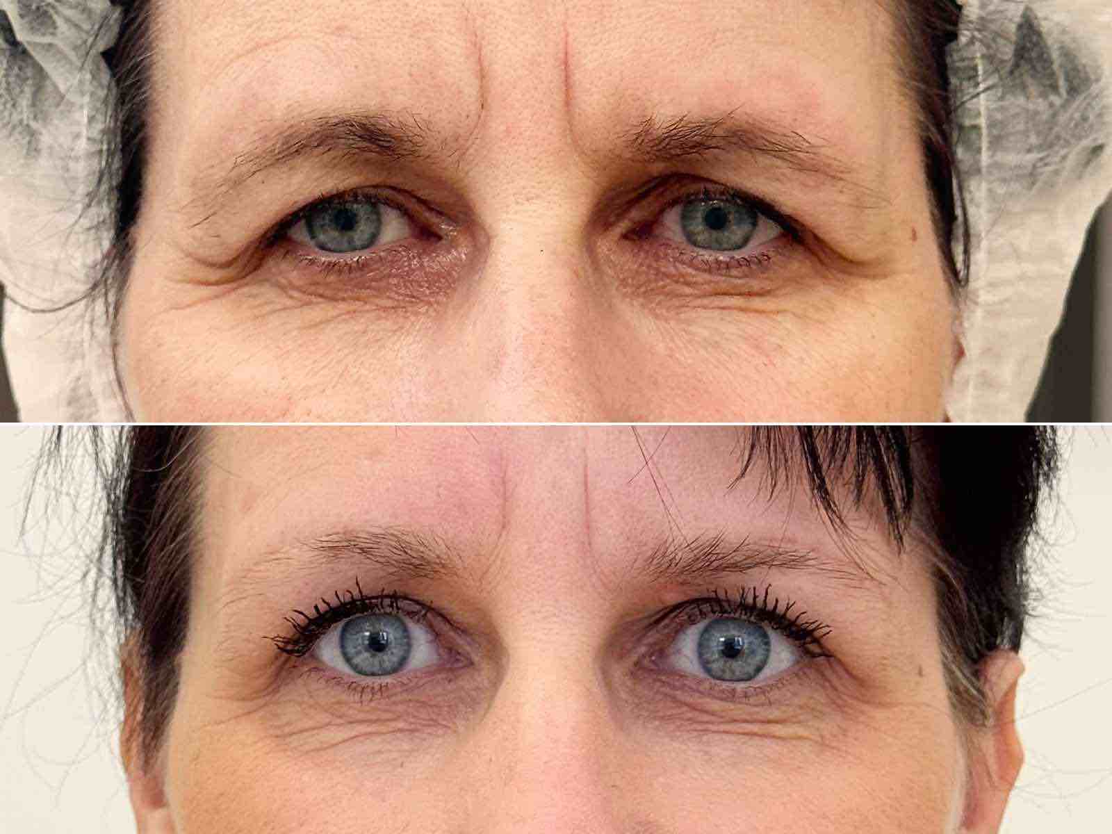 Přímý browlift řezem nad obočím