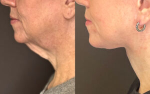 Redukce podčelistní žlázy při operaci Deep Plane Facelift a Necklift