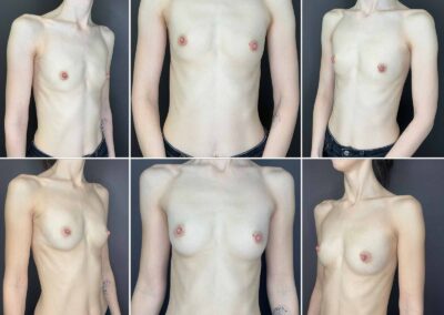 Augmentace zvětšení prsou vlastním tukem, lipofilling prsou, fatgrafting - MUDr. Radek Lhotský