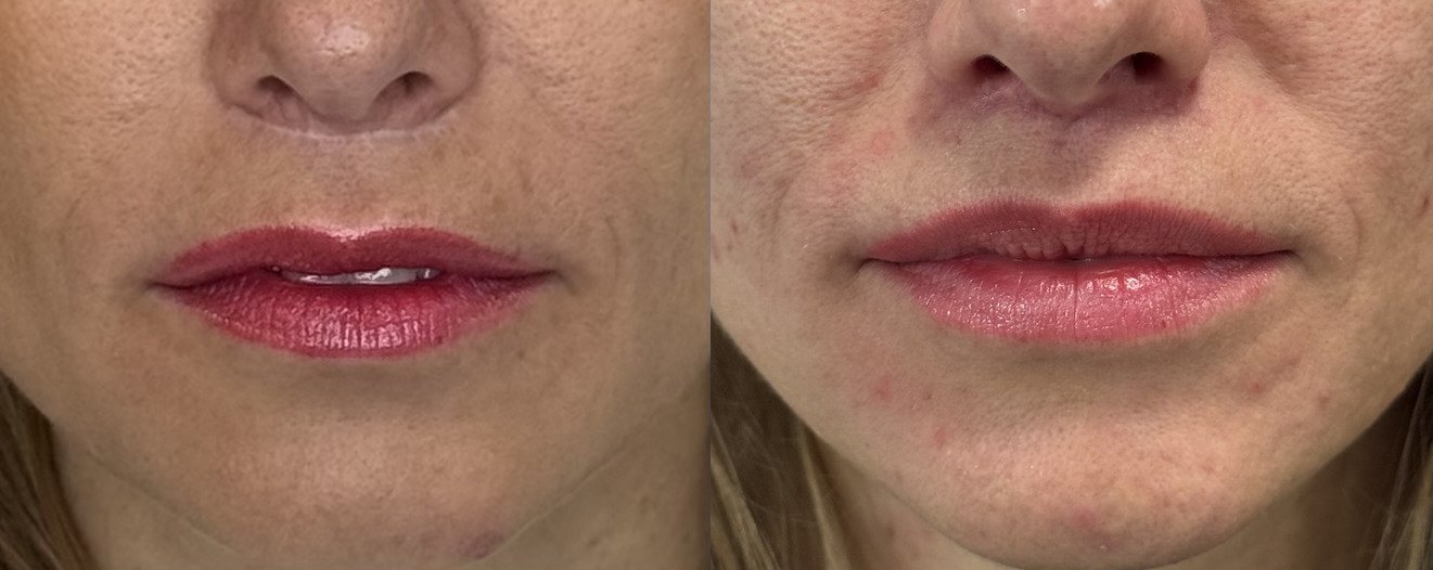 Liplift při operaci Deep Plane Facelift