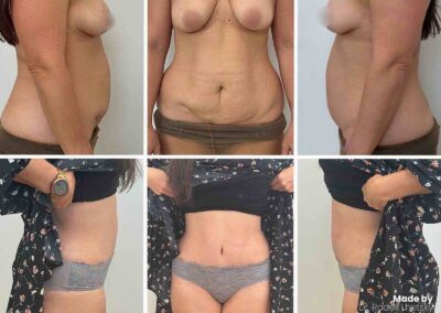 Abdominoplasty - Tummy Tuck before after Prague