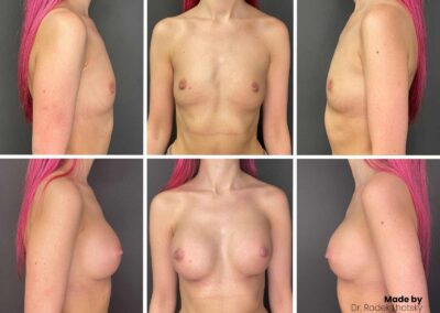 Augmentace - zvětšení prsou - ergonomické implantáty - MUDr. Radek Lhotský - před a po fotografie