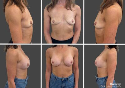 Brustvergrößerung - Vorher-Nachher Bilder Dr. Lhotsky Prag