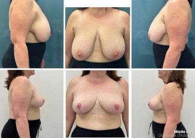 Breast reduction before after - Dr. Lhotsky Prague