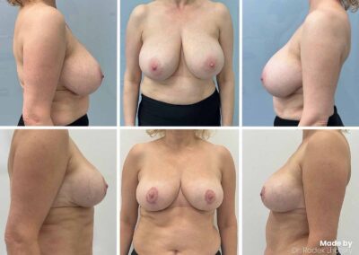 Breast reduction before after - Dr. Lhotsky Prague