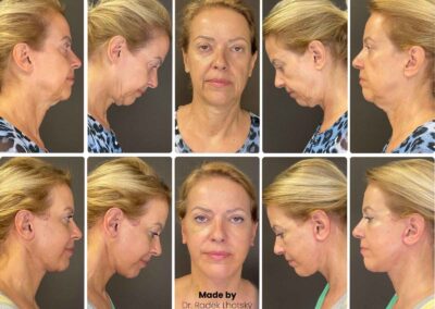 Facelift und Necklift - Gesichts- und Halsstraffung Frau - Vorher-Nachher Bilder Dr. Lhotsky Prag