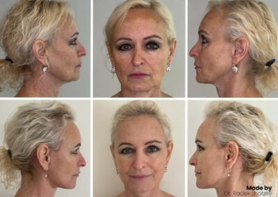 Facelift před a po fotografie - 6 týdnů po operaci - MUDr. Radek Lhotský