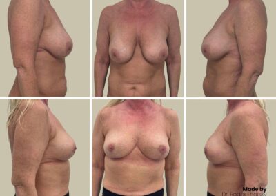 Extrakce implantátů, modelace prsou a doplnění vlastním tukem - před-po Dr. Lhotský