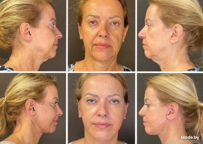 Deep plane facelift a necklift - před-po MUDr. Radek Lhotský