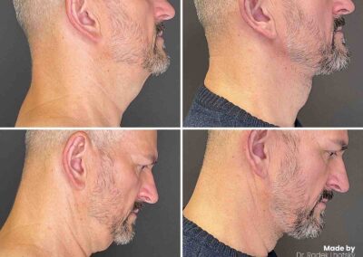Necklift - Halsstraffung bei Mann - Vorher-Nachher Bilder Dr. Lhotsky Prag