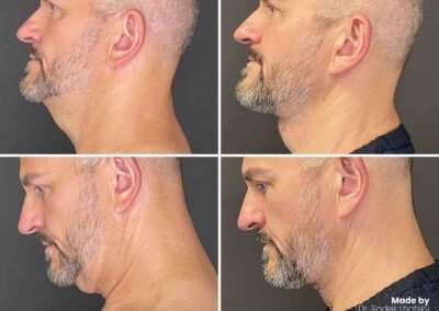 Deep necklift muž - před a po fotografie Dr. Lhotský