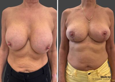 Vyjmutí implantátu a modelace prsou - před/po fotografie Dr. Lhotský